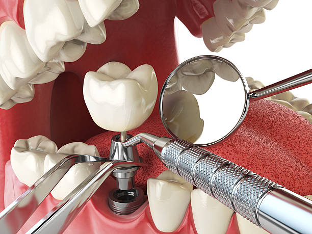 Best Urgent Care for Lost Fillings or Crowns in Way, NE